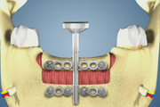 Distraction Osteogensis Nad Ant Bone view